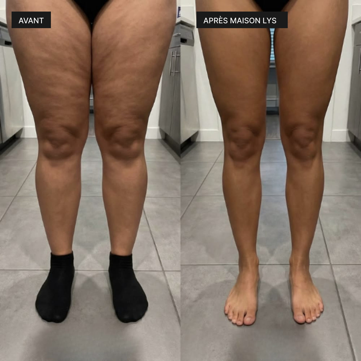 Avant après sur les jambes et les cuisses