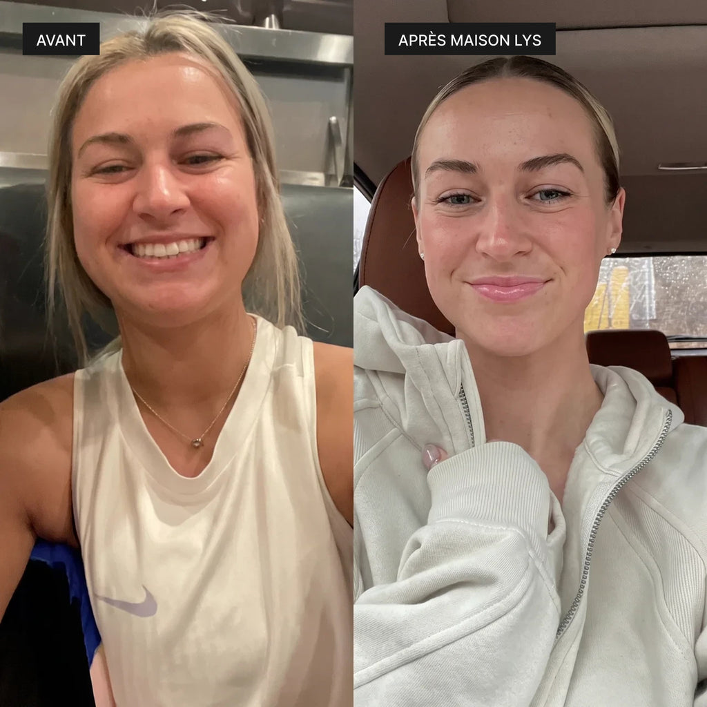 Avant après sur le visage