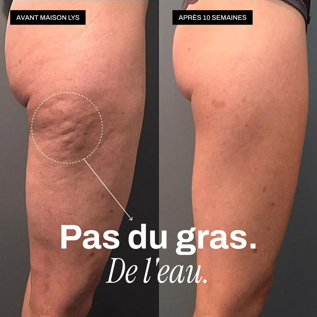 Avant / après — ce n est pas du gras mais de l eau